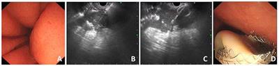 Current uses of electro-cautery lumen apposing metal stents in endoscopic ultrasound guided interventions
